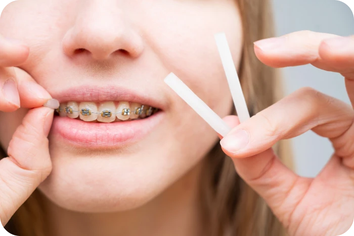Application de cire orthodontique sur un appareil dentaire