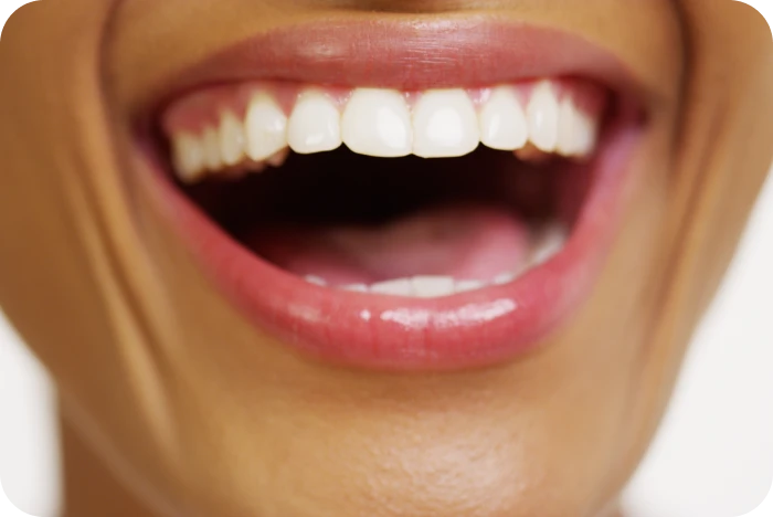 Sourire avec dents alignées grâce à un traitement de contention