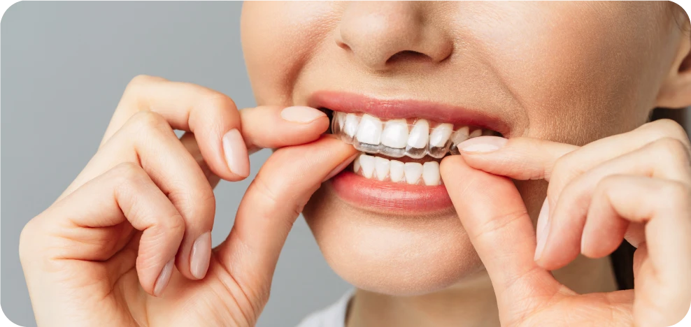 Gouttière de contention orthodontique