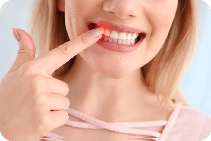 Inflammation des gencives chez une patiente