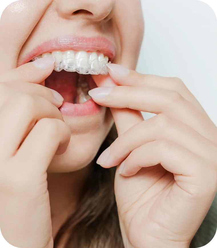 Pose d'un aligneur invisible sur les dents
