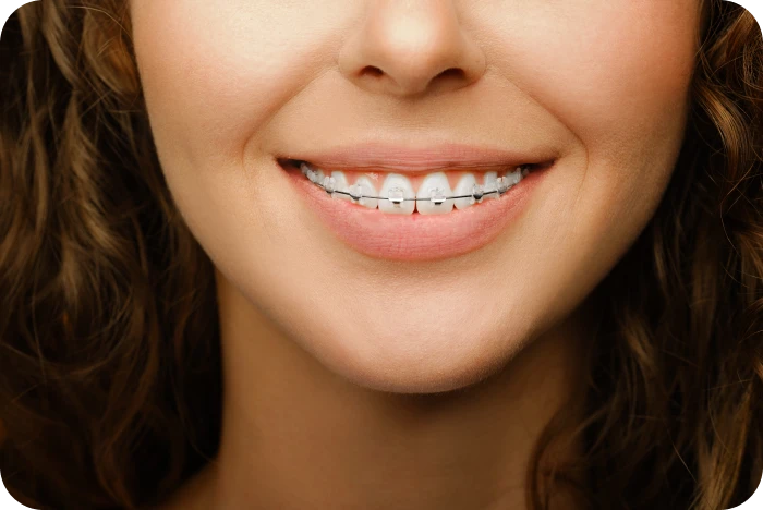 Sourire avec un appareil dentaire céramique