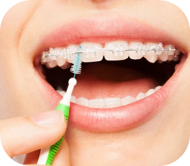 Brossage des dents avec bagues à l'aide d'une brossette interdentaire