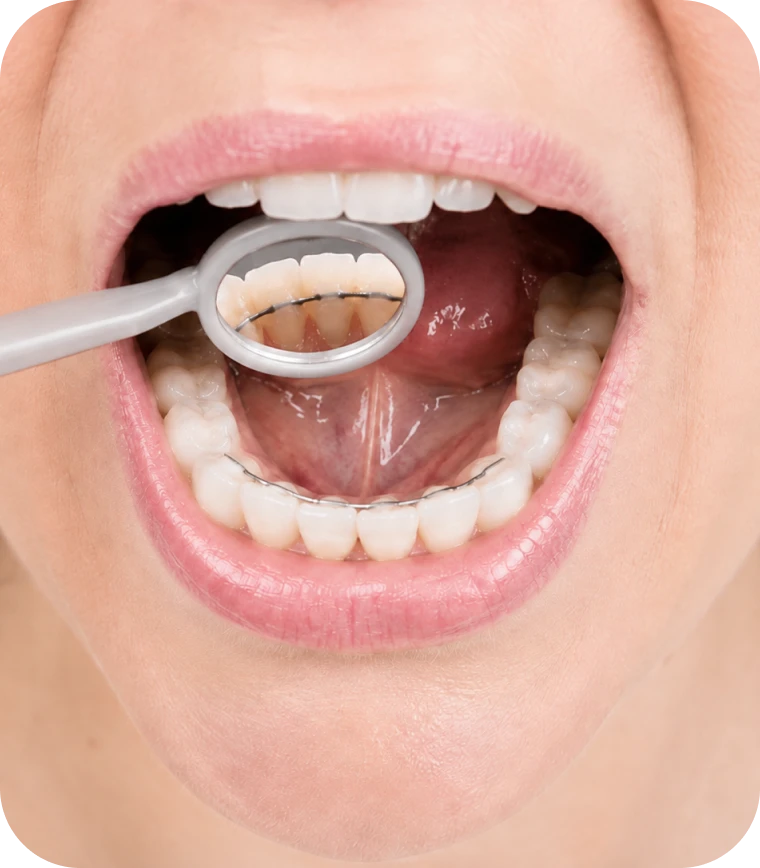 Contrôle de contention orthodontique avec miroir dentaire