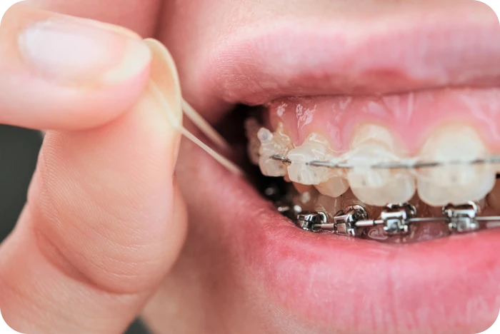 Élastiques intermaxillaires posés sur un appareil dentaire métallique