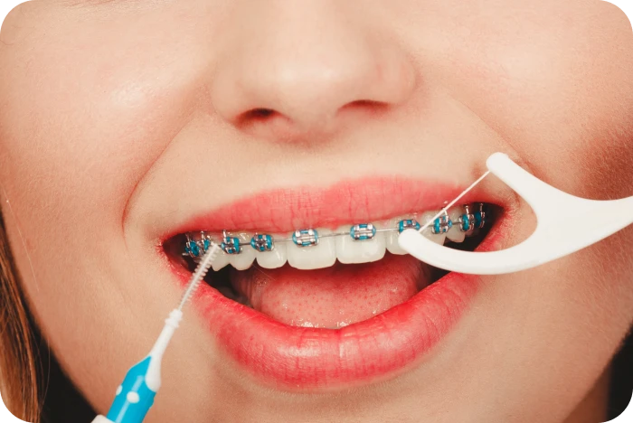 Brossage des dents avec un appareil dentaire métallique