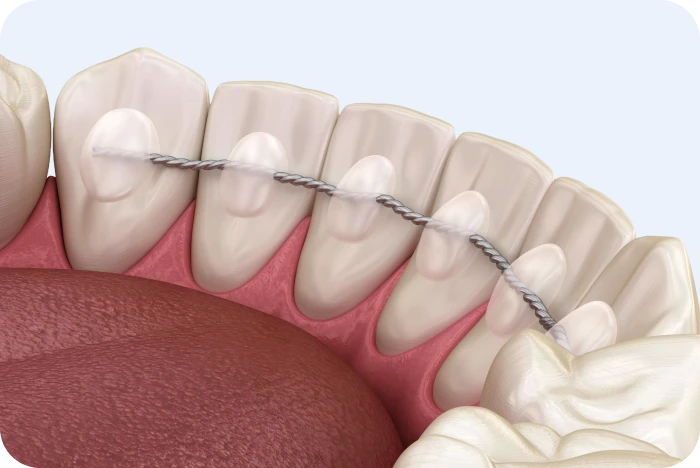 Illustration d'un fil de contention collé sur la face interne des dents