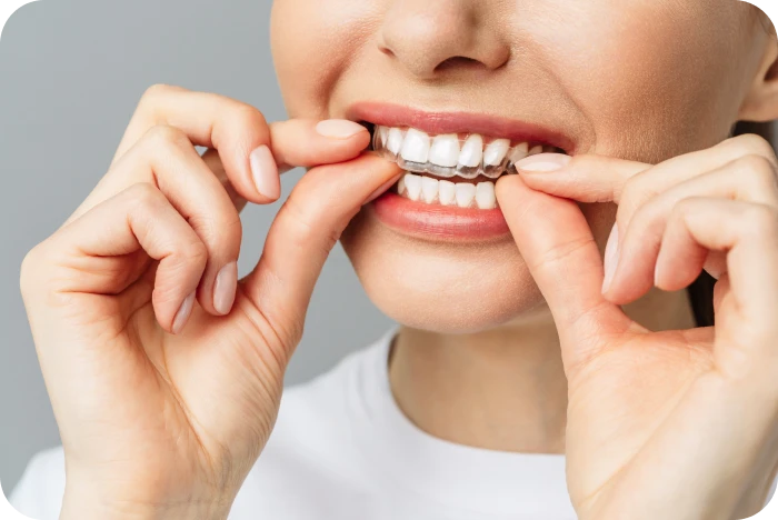 Mise en place d'une gouttière transparente sur les dents du haut