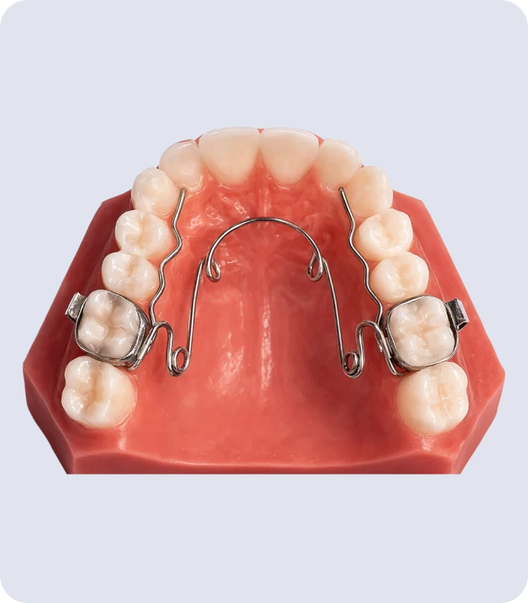 Modèle de quad helix sur moulage dentaire