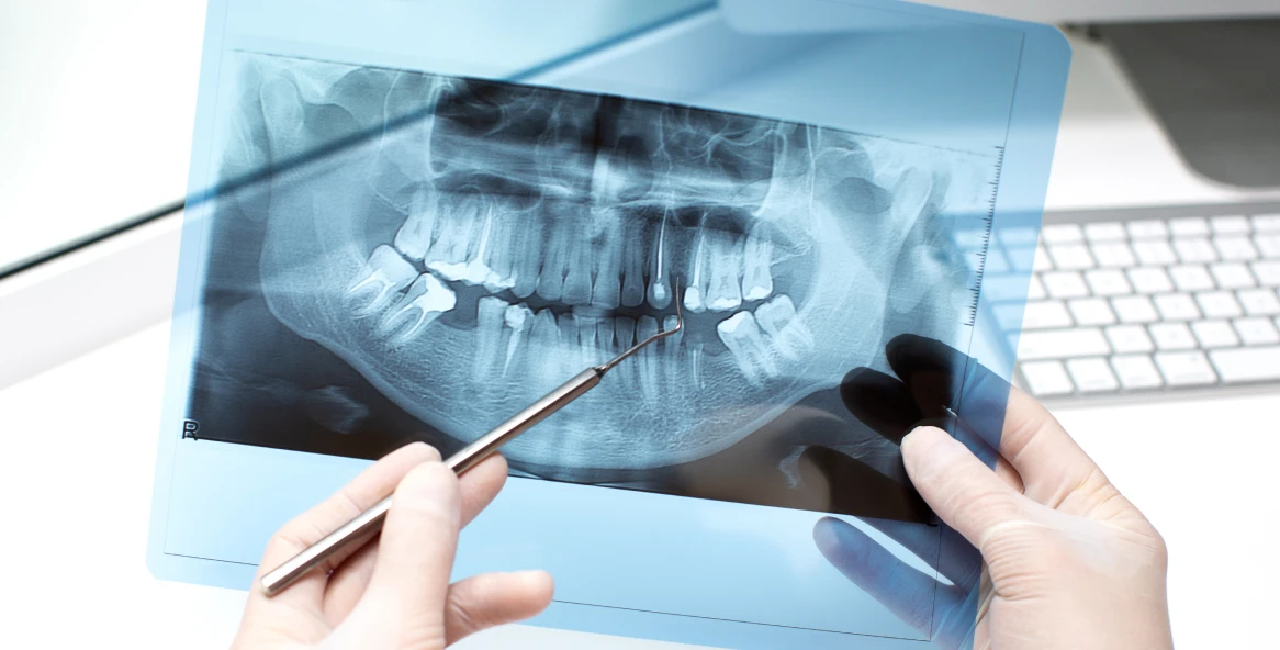 Radiographie panoramique dentaire