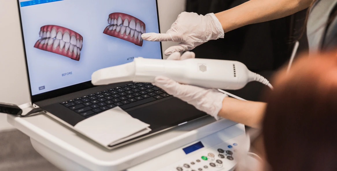 Prise d'empreinte avec un scanner intra-oral